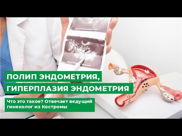 Полип эндометрия гиперплазия эндометрия. Что это такое? Отвечает ведущий гинеколог из Костромы смотреть онлайн