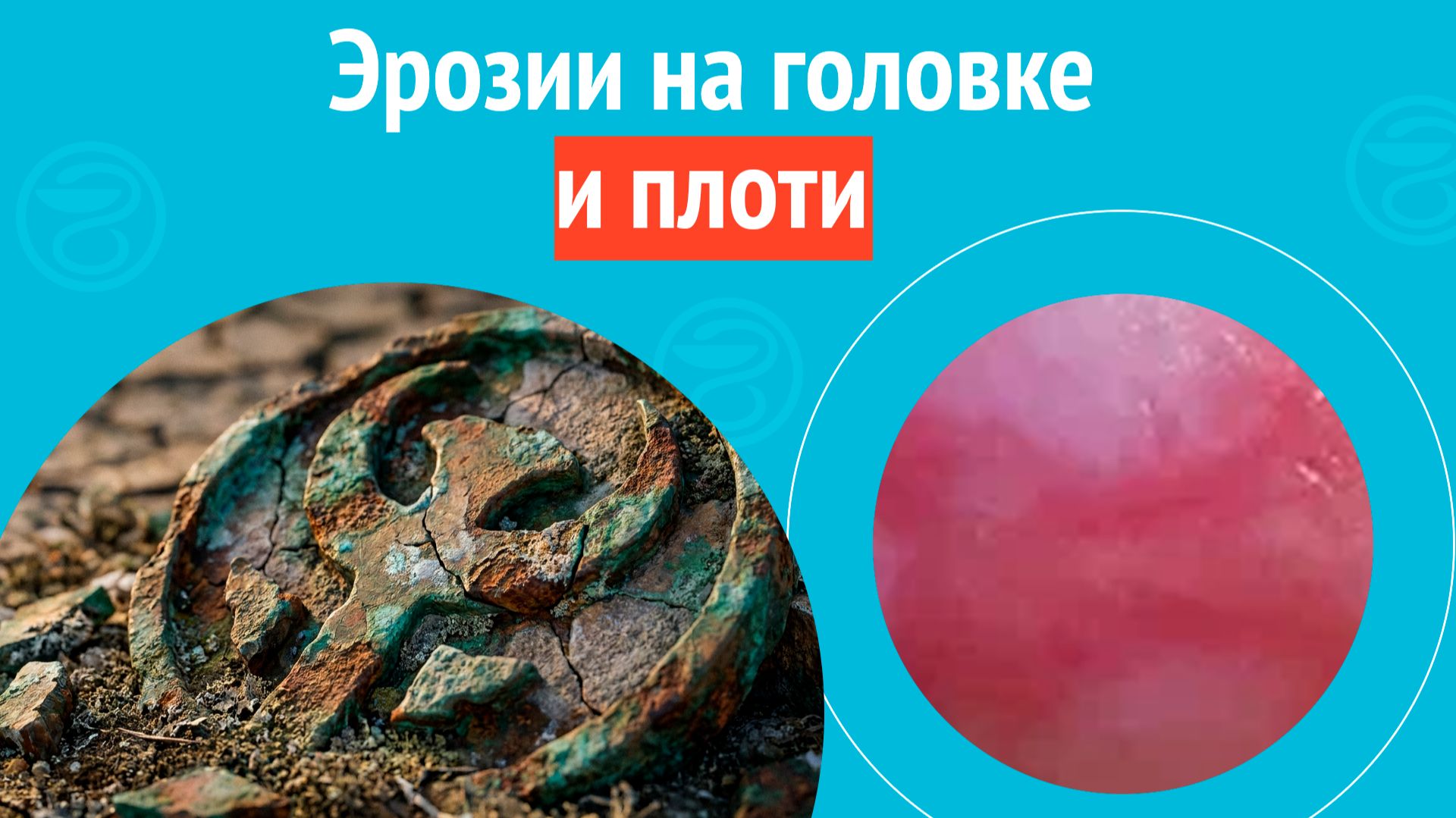 🥺 Эрозии на головке и плоти. Клинический случай №1694 смотреть онлайн