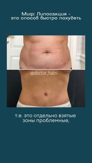 Правда или миф: липосакция — это быстрый способ похудеть?