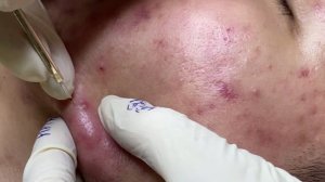 Удаление мелких прыщей и комедонов — полный кайф (ASMR)