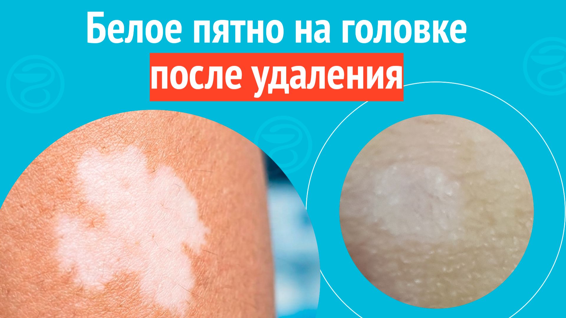 😕 Белое пятно на головке после удаления. Клинический случай №1692 смотреть онлайн