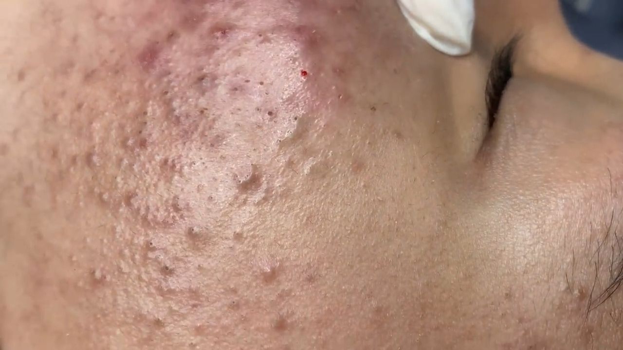 263 • Acne collection • АСМР • Relax Spa смотреть онлайн