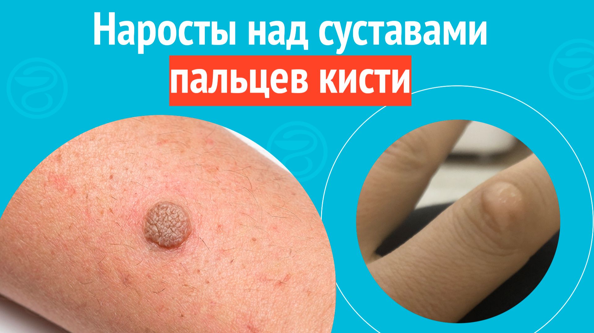 🤚 Наросты над суставами пальцев кисти. Клинический случай №1695 смотреть онлайн