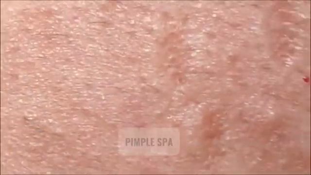 Жестокое удаление белых точек на лбу. ASMR — вы не поверите, что это за ощущения! смотреть онлайн