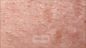Жестокое удаление белых точек на лбу. ASMR — вы не поверите, что это за ощущения!
