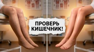 Варикоз, звёздочки, трофические язвы — всё решается через лимфу и кишечник
