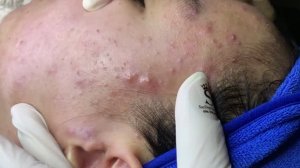 Удаление белых угрей и прыщей на коже у девушки