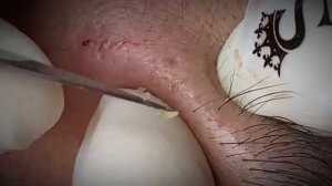 ВЫДАВЛИВАЕТ ПРЫЩИ И УГРИ. СОЧНОЕ РЕЛАКС ВИДЕО