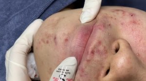 255 • Acne collection • АСМР • Relax Spa