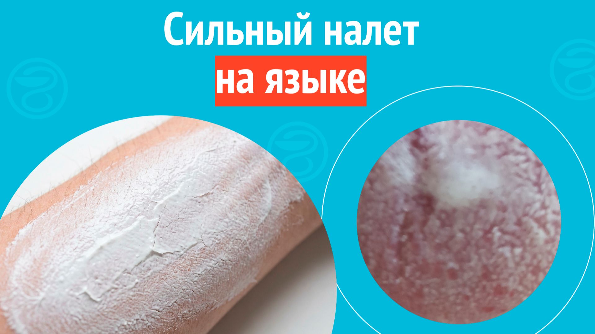 👅 Сильный налет на языке. Клинический случай №1693 смотреть онлайн
