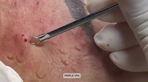 Лечение акне на лице, удаление черных и белых точек