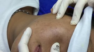 Экстракция открытых комедонов — достаём всё из пор