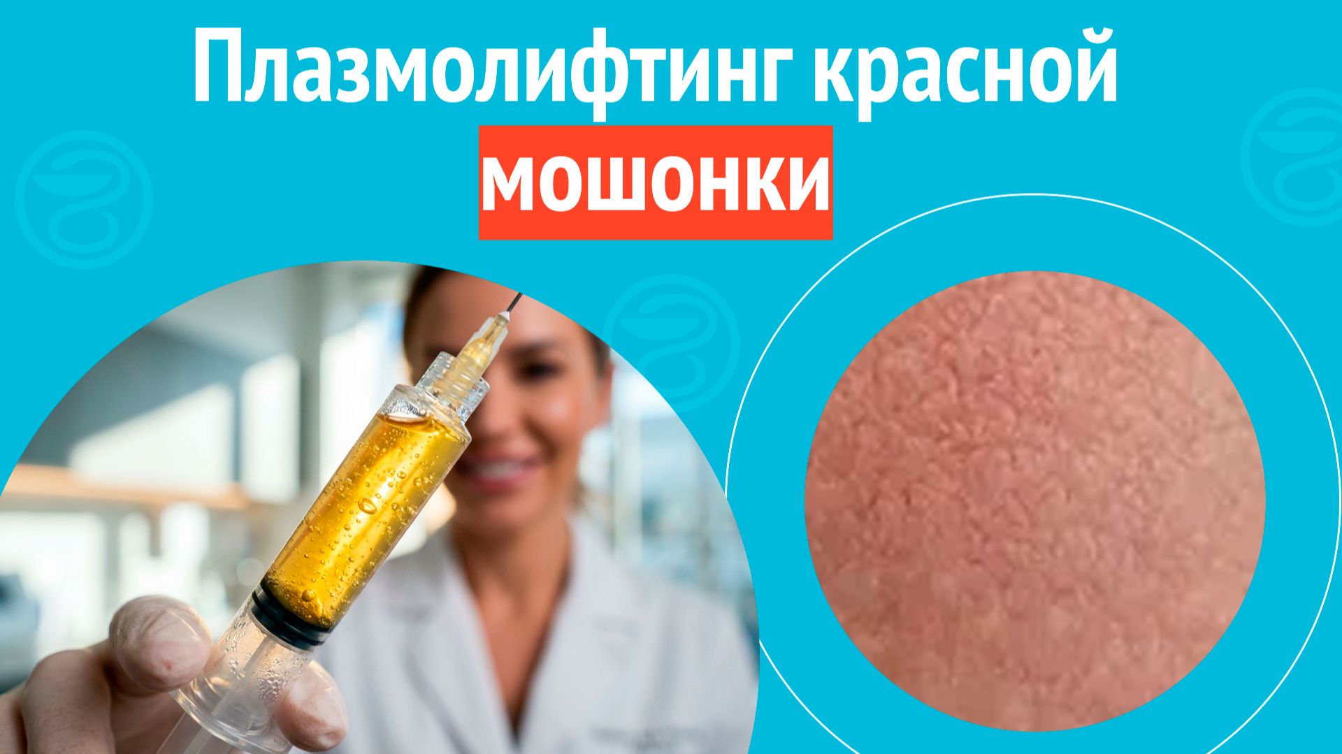 ✅ Плазмолифтинг красной мошонки. Клинический случай №1691 смотреть онлайн