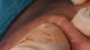 давить прыщи и угри жирные новое видео