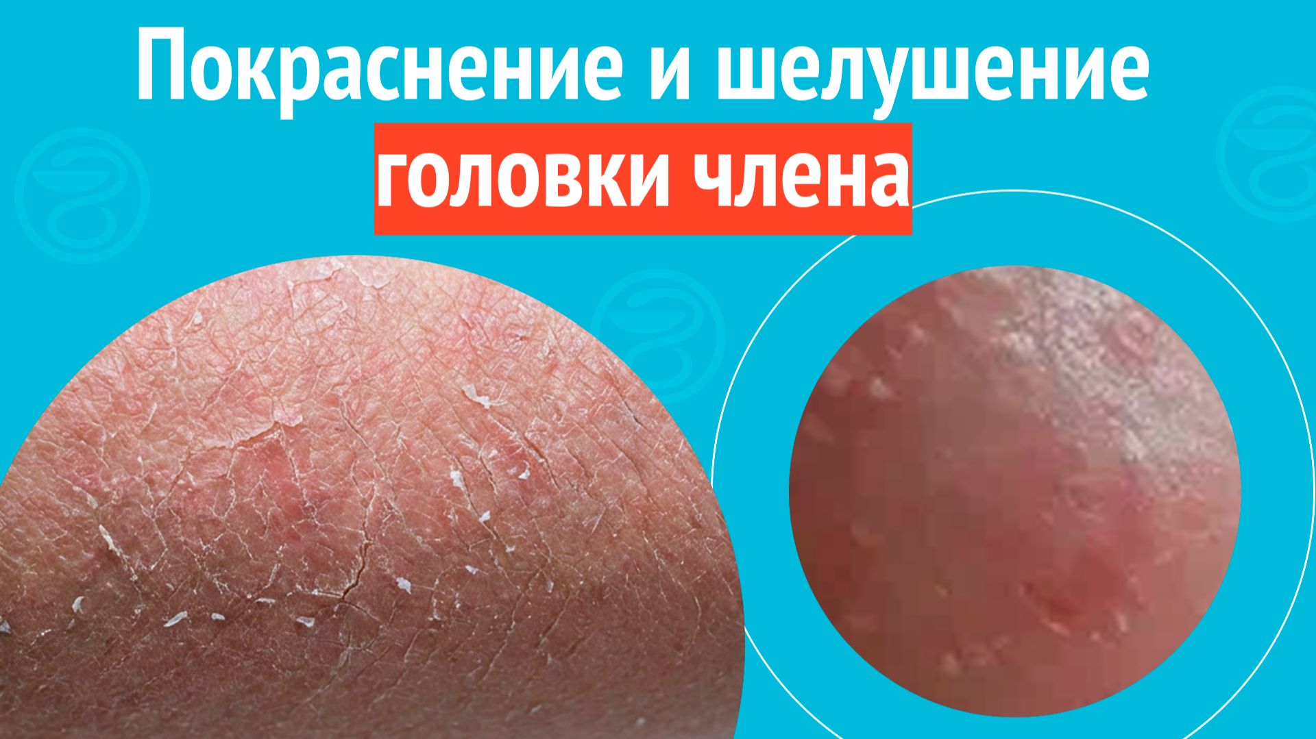 😢 Покраснение и шелушение головки члена. Клинический случай №1699 смотреть онлайн