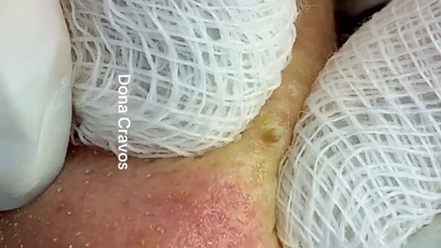 Deep Clean_ Removendo cravos abertos do nariz (blackhead extraction) смотреть онлайн