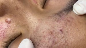 253 • Acne collection • АСМР • Relax Spa