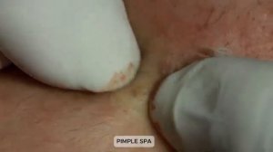 ВЫДАВЛИВАЕТ ПРЫЩИ И УГРИ. СОЧНОЕ РЕЛАКС ВИДЕО давить угри и прыщи