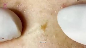 УДОВЛЕТВОРЯЮЩАЯ процедура удаления черных и белых точек на лбу ASMR — глубокая чистка пор