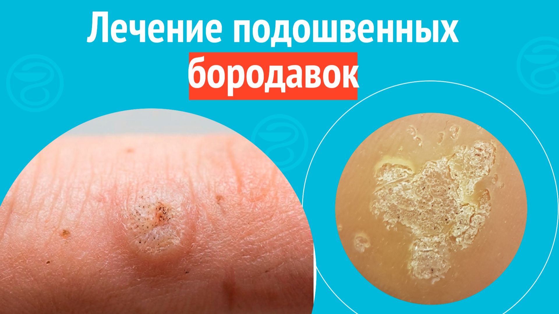 ✅ Лечение подошвенных бородавок. Клинический случай №1697 смотреть онлайн