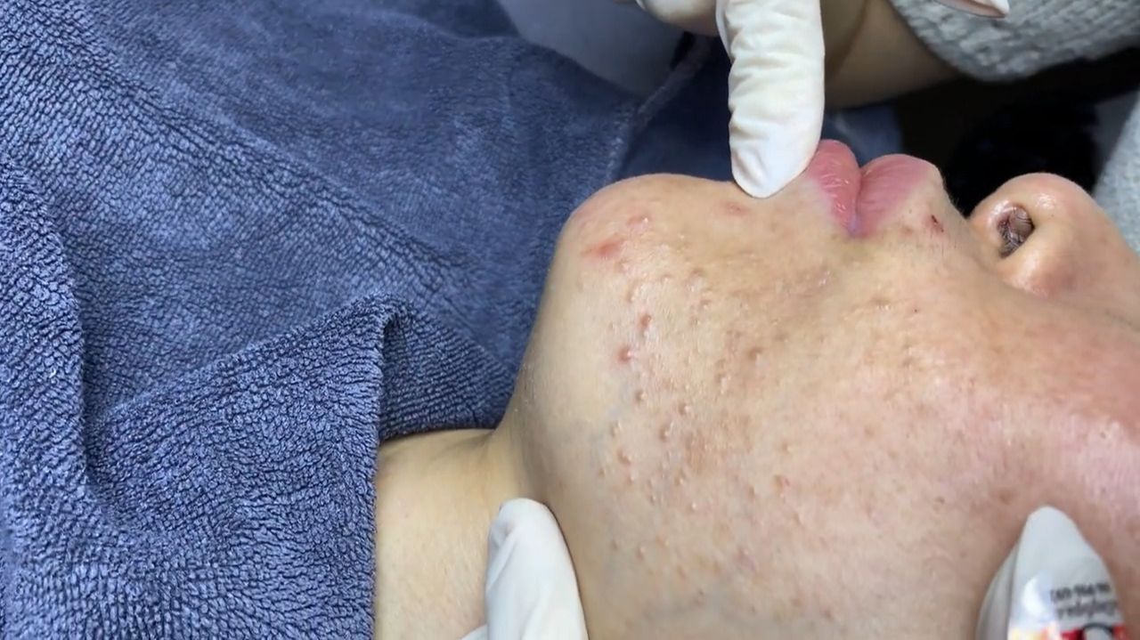 258 • Acne collection • АСМР • Relax Spa смотреть онлайн