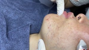 258 • Acne collection • АСМР • Relax Spa