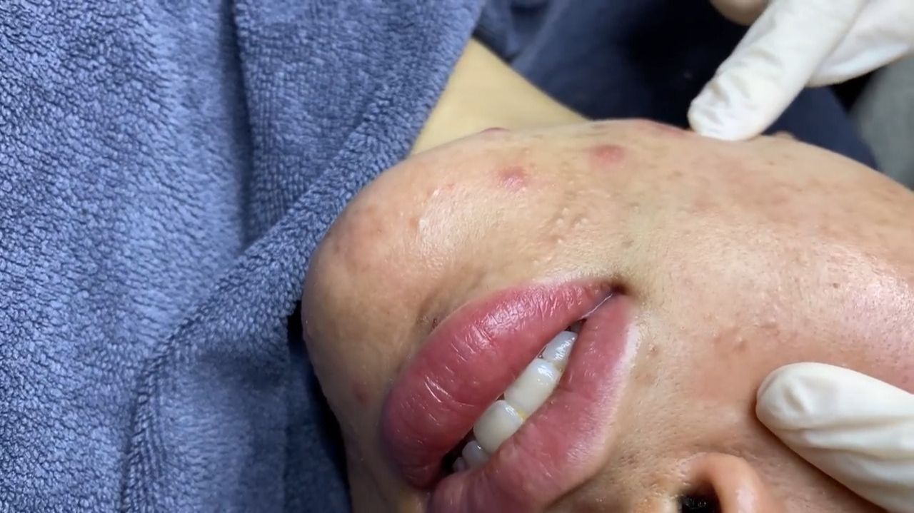 257 • Acne collection • АСМР • Relax Spa смотреть онлайн