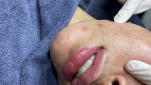 257 • Acne collection • АСМР • Relax Spa