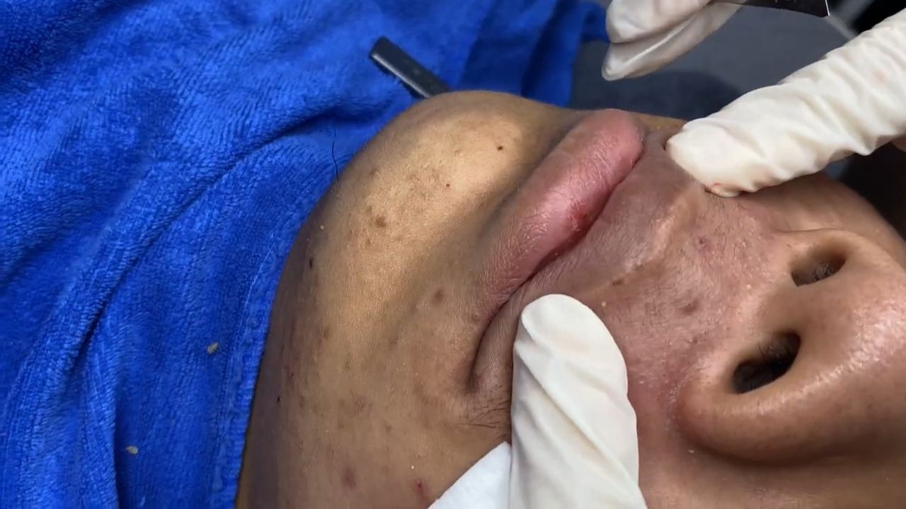 265 • Acne collection • АСМР • Relax Spa смотреть онлайн