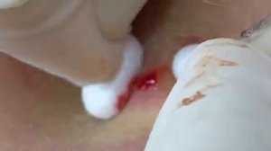 ВЫДАВЛИВАЕТ ПРЫЩИ И УГРИ. СОЧНОЕ РЕЛАКС ВИДЕО