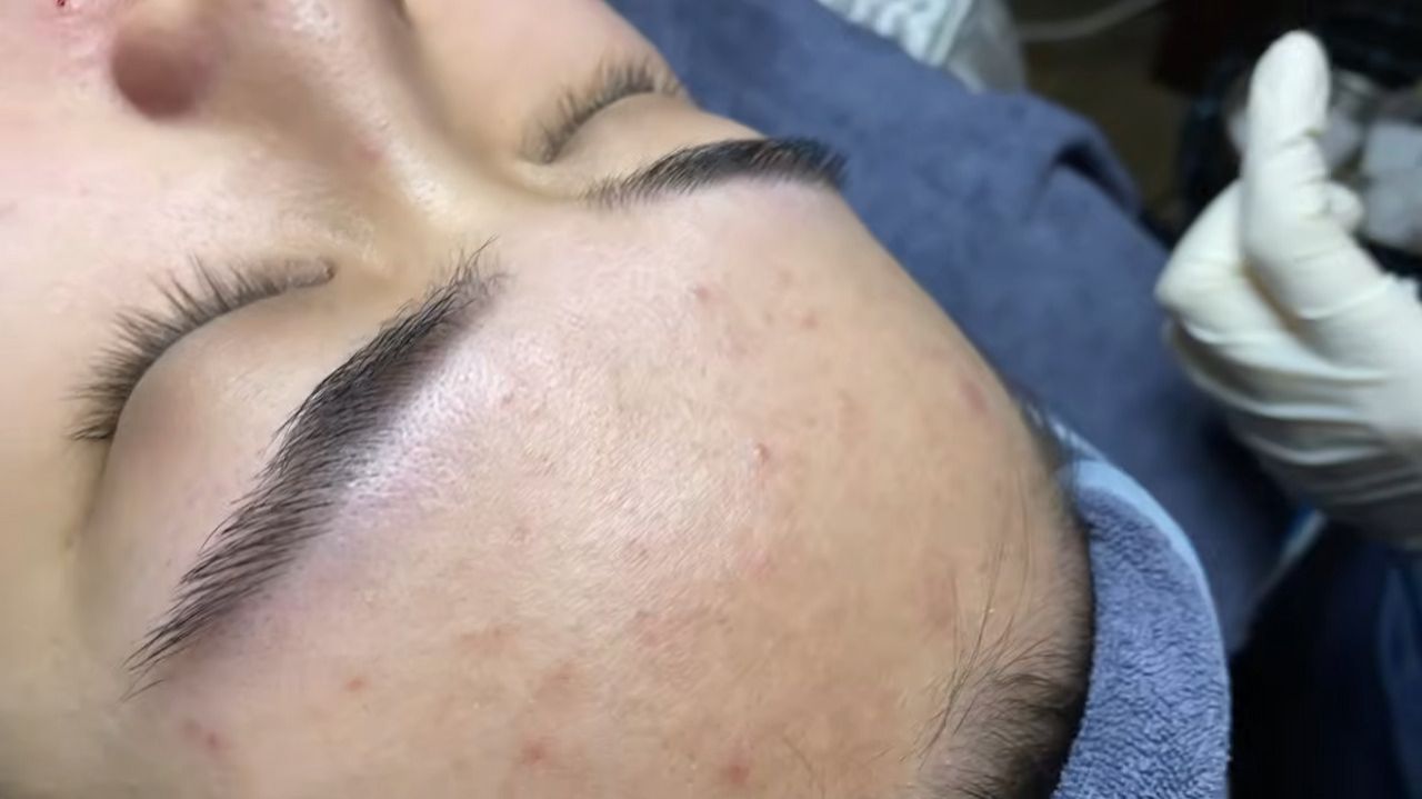 256 • Acne collection • АСМР • Relax Spa смотреть онлайн