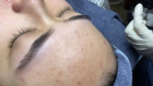 256 • Acne collection • АСМР • Relax Spa