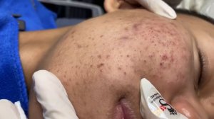 261 • Acne collection • АСМР • Relax Spa
