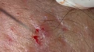 ВЫДАВЛИВАЕТ ПРЫЩИ И УГРИ. СОЧНОЕ РЕЛАКС ВИДЕО