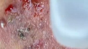 ВЫДАВЛИВАЕТ ПРЫЩИ И УГРИ. СОЧНОЕ РЕЛАКС ВИДЕО