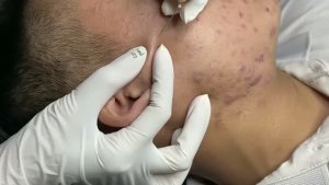 Удаление прыщей, черных точек и комедонов — профессиональная чистка
