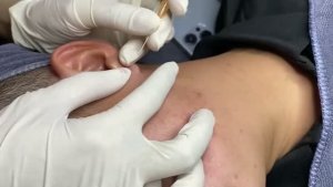 Удаление прыщей и черных точек — видео для смелых