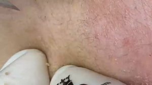 ВЫДАВЛИВАЕТ ПРЫЩИ И УГРИ. СОЧНОЕ РЕЛАКС ВИДЕО