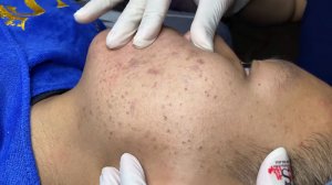266 • Acne collection • АСМР • Relax Spa