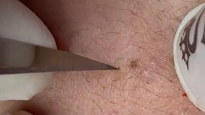 ВЫДАВЛИВАЕТ ПРЫЩИ И УГРИ. СОЧНОЕ РЕЛАКС ВИДЕО