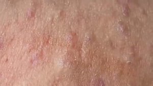 ВЫДАВЛИВАЕТ ПРЫЩИ И УГРИ. СОЧНОЕ РЕЛАКС ВИДЕО