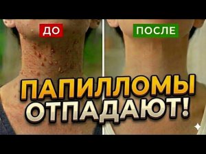 ПАПИЛЛОМЫ КАК ОГНЯ БОЯТСЯ ЭТОГО СРЕДСТВА!