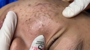 260 • Acne collection • АСМР • Relax Spa