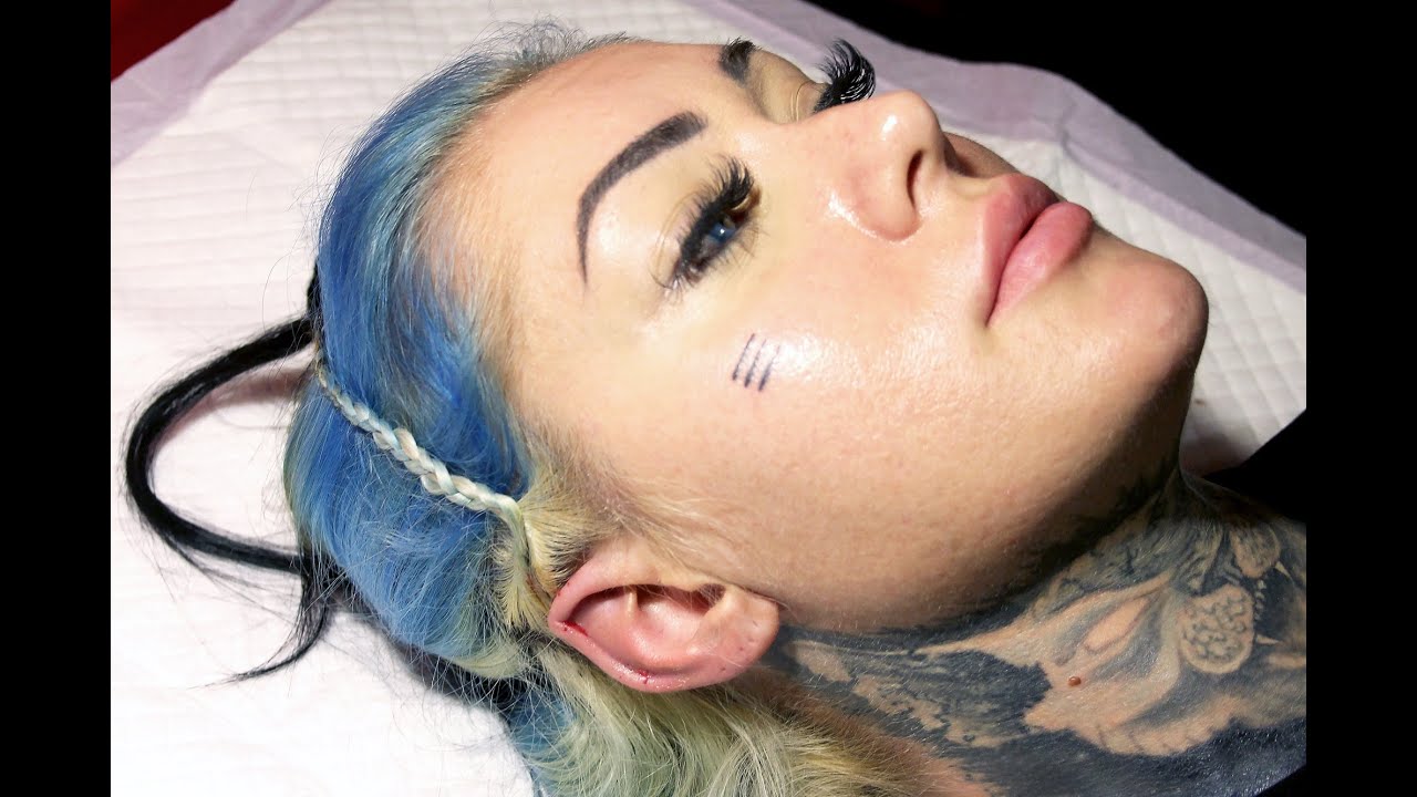Эльфийские ушки сразу после снятия швов. Pointed ears. Модификация тела смотреть онлайн