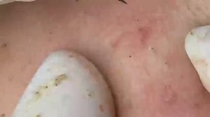 ВЫДАВЛИВАЕТ ПРЫЩИ И УГРИ. СОЧНОЕ РЕЛАКС ВИДЕО давить угри и прыщи