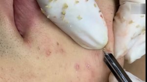Новое удаление черных точек — чистая кожа без усилий
