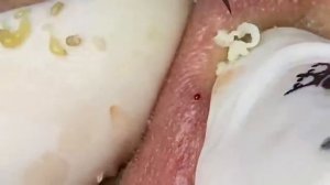 ВЫДАВЛИВАЕТ ПРЫЩИ И УГРИ. СОЧНОЕ РЕЛАКС ВИДЕО давить угри и прыщи