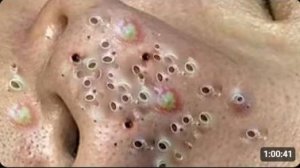 ВЫДАВЛИВАНИЕ ПРЫЩЕЙ ДЛИННОЕ ВИДЕО НОВОЕ (1)