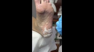 Семинар ФП и Микоз. Часть 1