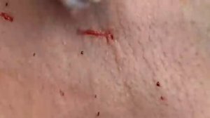 ВЫДАВЛИВАЕТ ПРЫЩИ И УГРИ. СОЧНОЕ РЕЛАКС ВИДЕО